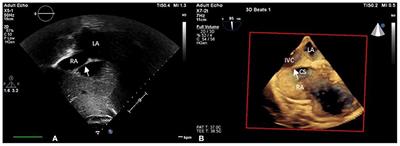 A Rare Complication During Transcatheter Closure of Double Atrial Septal Defects With Incomplete Cor Triatriatum Dexter: A Case Report